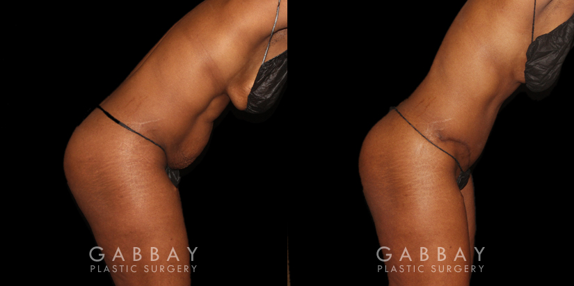 Patient following tummy tuck and hernia repair, showcasing results from multiple angles. Note the absence of stomach overhang in the leaning forward position, demonstrating effective tightening of multiple tissue layers.