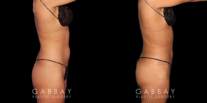 Multiple angle view of Caucasian patient in her mid-30s before and after mini Brazilian butt lift surgery and combined 360 liposuction for body contouring and butt augmentation. Liposuction provided improved abdominal contouring focusing on the abdomen, waist, and tailbone areas. The transferred fat settled well into round-shaped buttocks for a stable cosmetic enhancement as part of this skinny BBL.