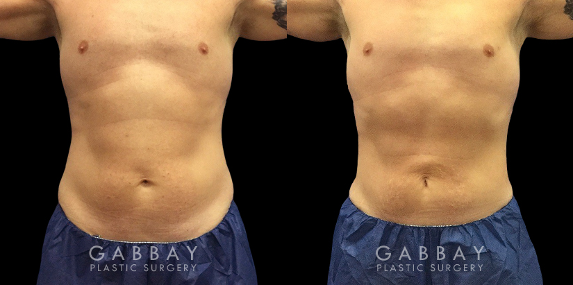 Male patient after abdominal liposuction, improving the patient’s torso shape and resulting in a more masculine contour from each angle with a flat abdomen. Compare to the sloping belly roundness before.