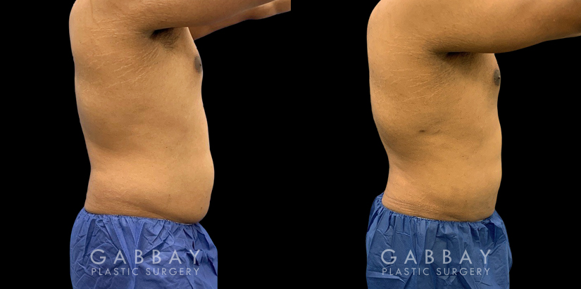 Male patient following 360 liposuction to the abdomen, sides, and back for a more youthful contour while maintaining a masculine feel to the body shape. The result is a tighter overall torso appearance.