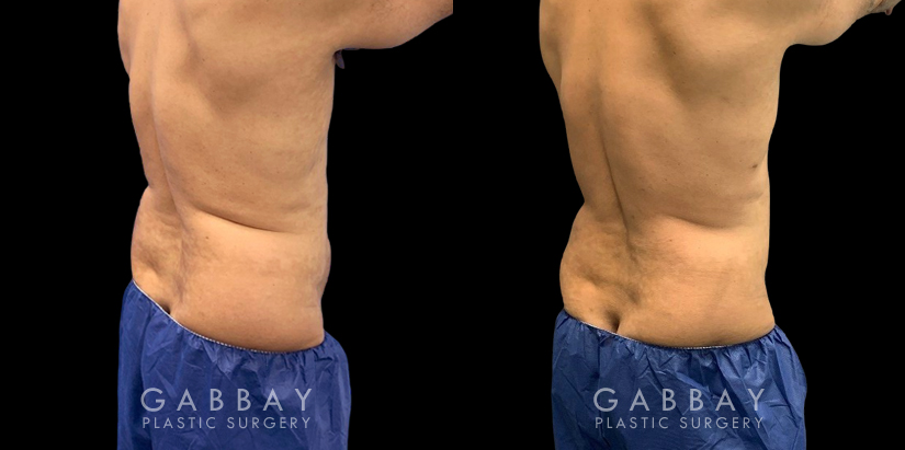 Male liposuction before-and-after photo for 360 lipo showing a result in a slimmer waist and flatter abdominal area for an enhanced torso contour. Flanks are significantly slimmed and present a toned silhouette.