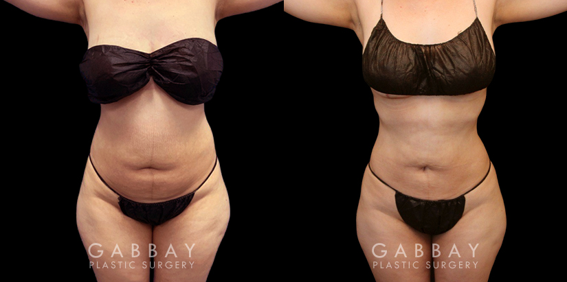 Before and after surgical liposuction for the abdomen, removing stubborn fat with minimal use of invasive techniques. Note the visible belly fat reduction for a smoother contour.