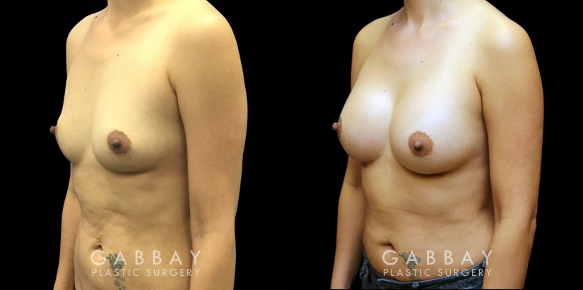 Breast augmentation results for patient in her 40s. Volume increase is mild but retains a natural shape to the breasts with retained symmetry.