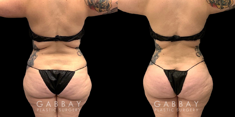 Female liposuction results for a flatter abdomen. Note how fat reduction was done with her natural figure in mind for results that match her unique features.