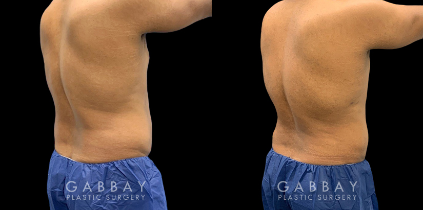 Male patient after surgical removal of abdominal fat. His liposuction results emphasize the naturally masculine form of his torso with a tighter figure overall.