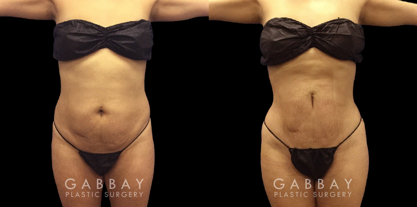 Female patient before and after belly liposuction, enhancing her figure while providing a flatter stomach visible from the side and front. Note the lack of visible scarring.