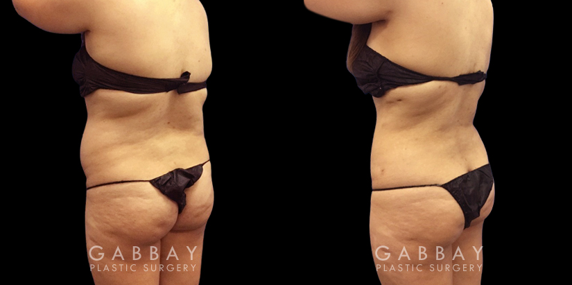 Patient’s surgical belly fat removal results reveal significant slimming after her procedure, with virtually no belly overhang for a flat profile contour.