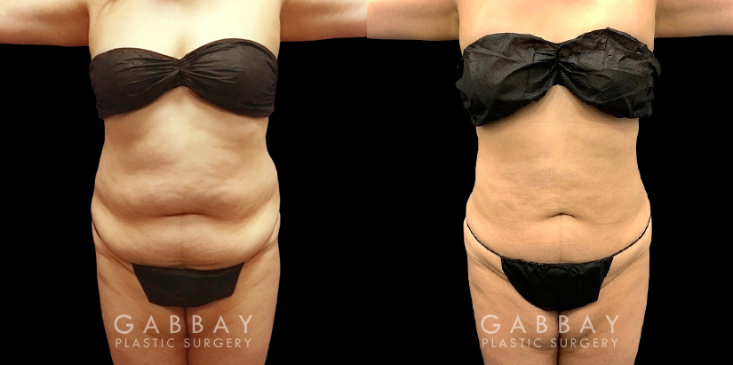 Mid 40s female patient after abdominal liposuction results have full healed, showing a tightened lower torso with belly rolls smoothed out for a flatter overall contour.