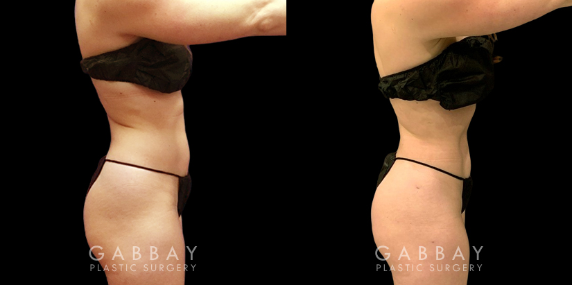 Late 20s female patient with minor stubborn fat wanted to complete her efforts to lose weight. Stomach area liposuction allowed her to achieve a flat abdominal area that looks great from every angle.