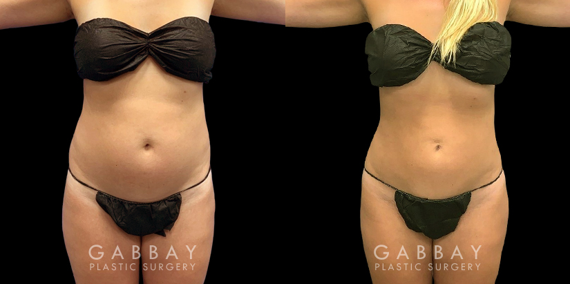 Patient after mild liposuction, demonstrating a significantly flatter stomach area from the profile angle. Patient’s recovery was without complications, and lead to virtually no visible scarring.