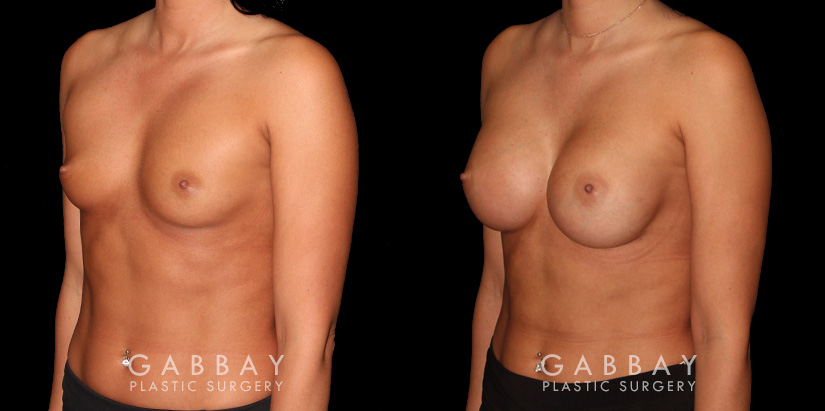 Patient results for breast augmentation. Note the rounded shape and lack of visible scarring. Patient’s recovery was smooth, absent of complications.