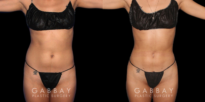 Before-and-after for patient with combined cosmetic surgeries, including BBL, abdominal lipo. Note the 360-degree slimming with enhanced buttocks roundness from the natural fat transfer.