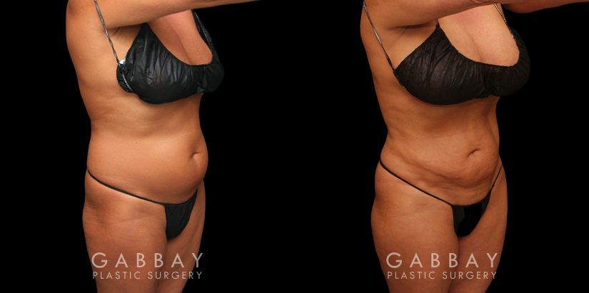 Female African-American patient after liposuction and J plasma treatment to her full abdomen, reducing her bulging belly and to tighten and restore loose skin.