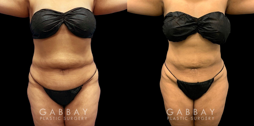 Patient after a traditional liposuction for the stomach (abdominal) area, resulting in a decrease in bulging belly fat (rolls) with a notable restoration of her natural body shape.