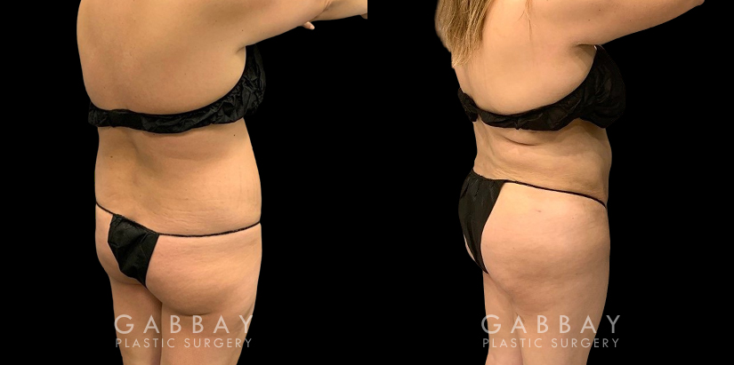 Female patient in her middle years after an abdominal liposuction surgery. The slimmed portions of the stomach area contribute to a more shapely appearance overall.
