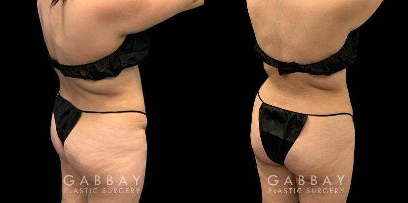 Patient who wanted mild liposuction to reduce tummy bulge from stubborn fat, with subtle results that lend a more balanced figure. Note how the puncture sites healed well for little to no visibility.