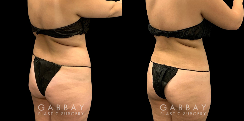 Before and after liposuction surgery for reducing mild bulging pockets of fat on the upper and lower abdomen, restoring a tighter stomach appearance without and bulging fat.