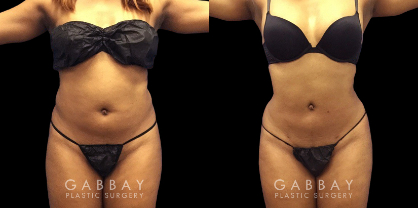 Younger female patient showcasing her results after belly fat removal via liposuction surgery. Note the reduction of ‘love handles’ and a flatter stomach for a defined lower torso aesthetic.