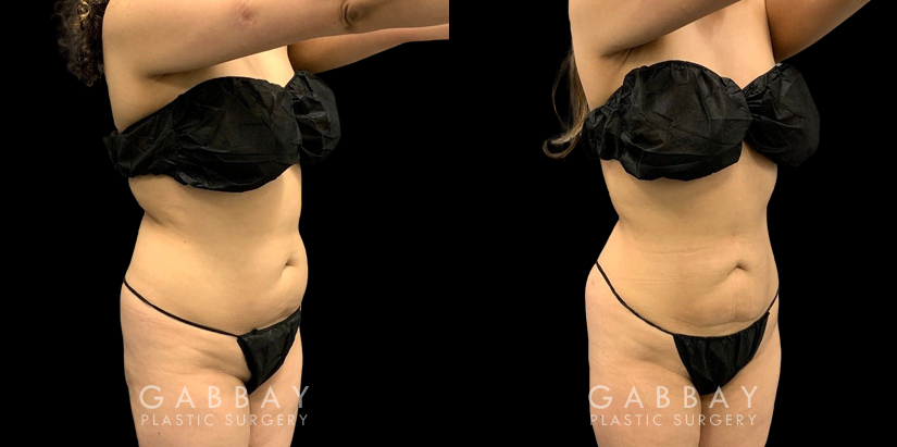 Patient with mild liposuction for the abdomen to help reduce some of the stubborn pockets of fat while also slimming the waist for a renewed youthful shape.