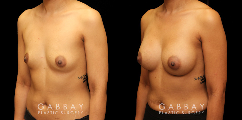 Patient 15 3/4th Left Side View Breast Augmentation Silicone Implants Gabbay Plastic Surgery