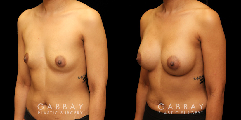 Before and after silicone implants for female patient. Her breast augmentation went smoothly and the recovery was without complications.