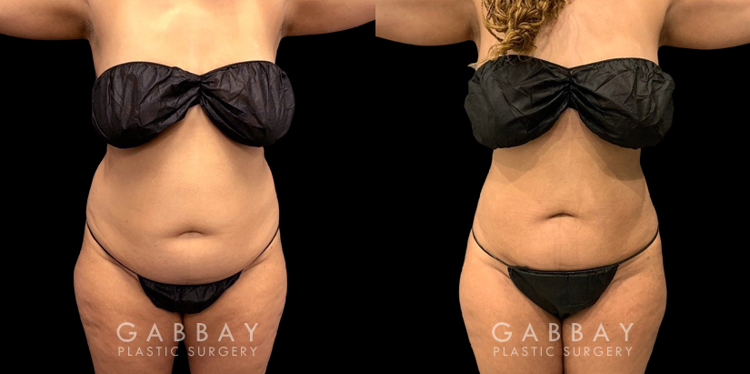 Patient who wanted to address a more significant amount of fat over the belly area. Using targeted liposuction, Dr. Gabbay removed the fat while keeping a balanced shape and aesthetic to the abdominal area.