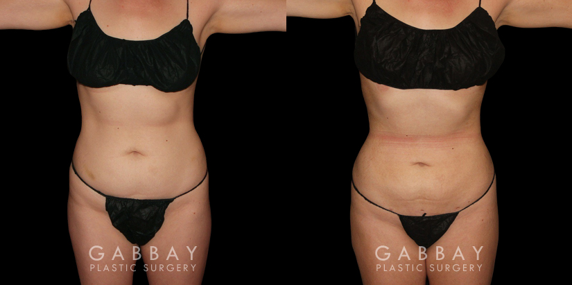 Patient 46 Front View Mastopexy and Liposuction Gabbay Plastic Surgery