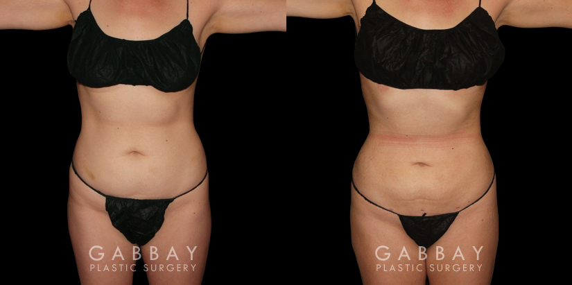 Before-and-after photos for female patient who underwent both a breast lift and belly fat removal via liposuction. Results together create a full ‘lifted’ appearance for the patient’s entire body.