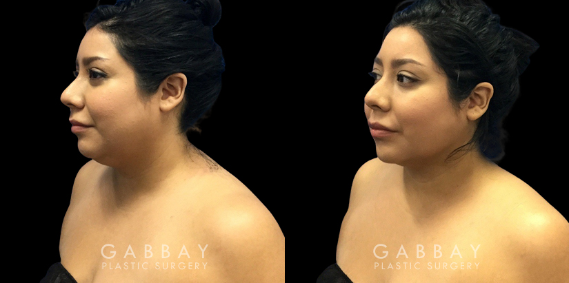 Patient 08 3/4th Left Side View Lipo Neck Gabbay Plastic Surgery