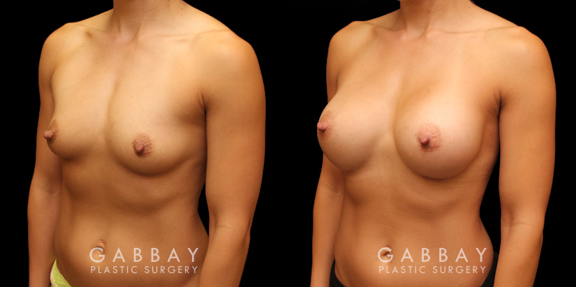 Patient photos showing before and after her breast augmentation procedure, with notable breast size increase while maintaining a balanced aesthetic.