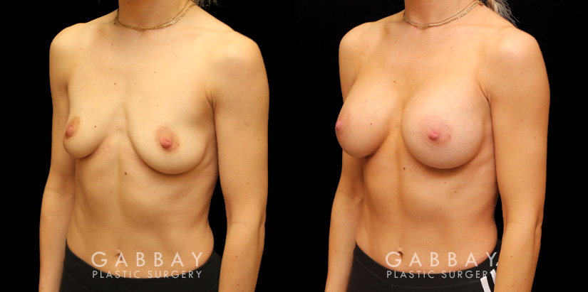 Silicone breast augmentation results after full recovery. Multi-angle view shows the boost to volume from each side for an alluring profile.