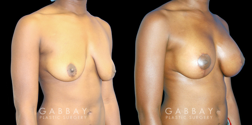 Silicone breast augmentation before-and-after photos demonstration enhanced breast size. Patient combined augmentation with a breast lift for improved breast position as well.
