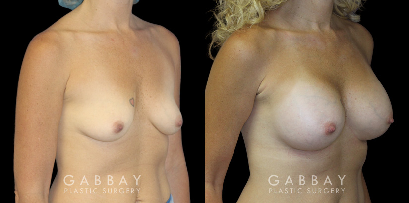 Patient in her mid 40s following breast augmentation. Before-and-after photos show her fully healed results from each angle, demonstrating the improved breast volume.