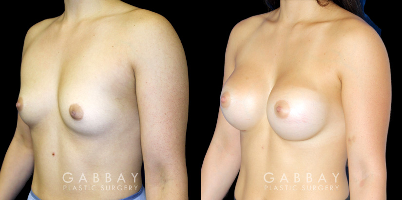 Patient with silicone implants, photos demonstrating final breast size after complete and uncomplicated recovery period. Note the improved profile and side angles, with no visible scarring.