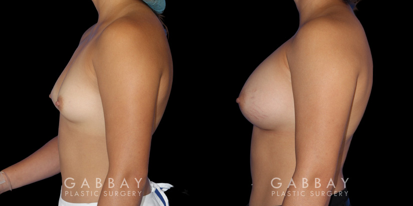 Photos showing patient following complete recovery from breast augmentation with silicone implants. Breast volume increased from minimal size to full, refined volume.