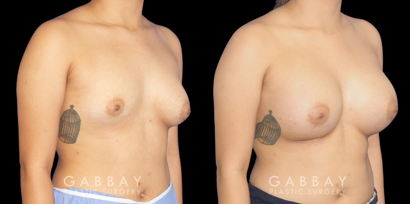 Silicone breast augmentation results, with patient having notable increase in breast volume and protrusion. But the breasts still maintain a balance between them.