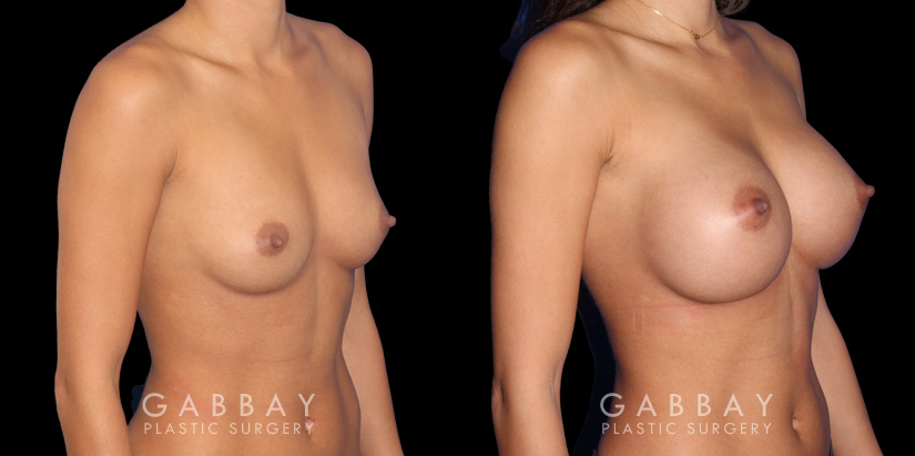 Breast augmentation patient with final results Note the significant increase in breast volume while keeping the shape within natural bounds. Note the absence of visible scarring which is rare with such increases in breast volume.