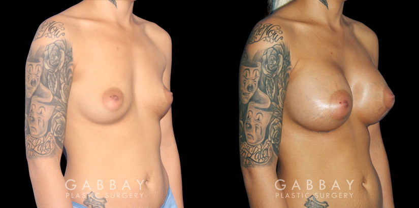 Before-and-after photos for breast augmentation with saline implants. The choice of saline implants allowed for more dramatic increase in breast size while having no visible scars.