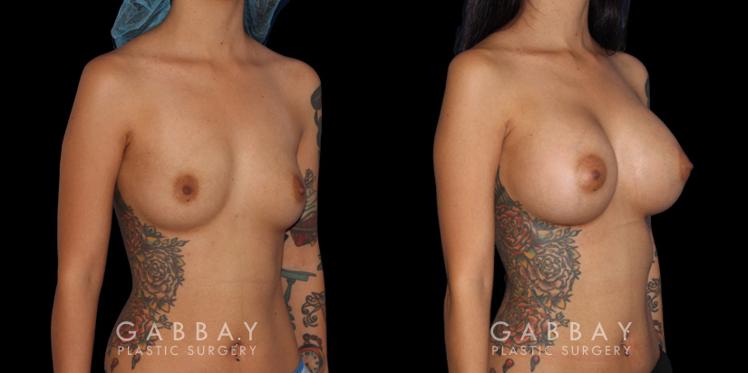 Silicone implant breast augmentation results for younger female patient. Multi-angle view allows for demonstration of the enhancement to her profile and overall silhouette contour.