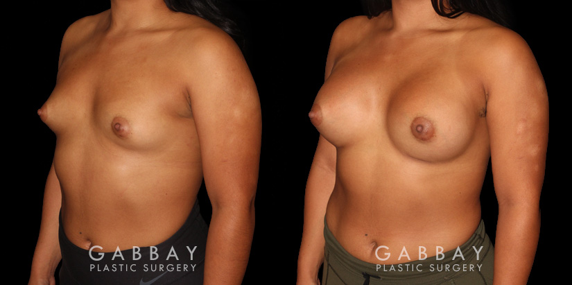 This is a young woman with a tuberous or constricted breast deformity. The lower portion of the breast developed more tightly than the rest of the breast. She wanted a more full, but natural breast appearance. She had silicone breast augmentation, with placement of an Allergan naturelle soft touch silicone breast implant through a lower breast/inframammary fold incision. Her moderate profile implants were 310 cc. Patients like this are prone to lower breast complications such as a double bubble, but with careful performance of the operation, she easily avoided this complication.