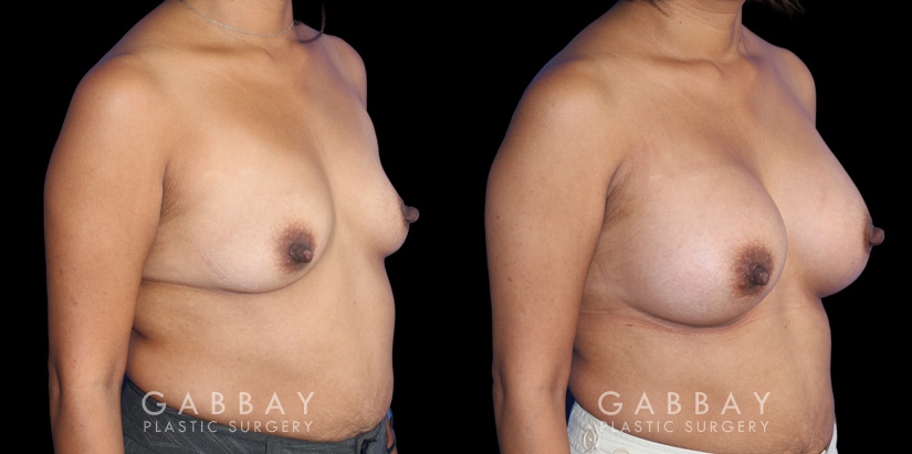 Patient before and after silicone implants with complete, uncomplicated recovery. Volume increase is notable while also improving the balance between breasts without resorting to unnatural perfect symmetry.