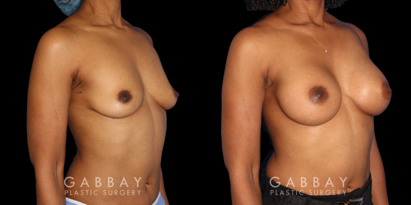 Before-and-after photos for saline implant breast augmentation patient. Her implant choice allowed for more natural shape and slope to the breasts, most notable in the profile view.