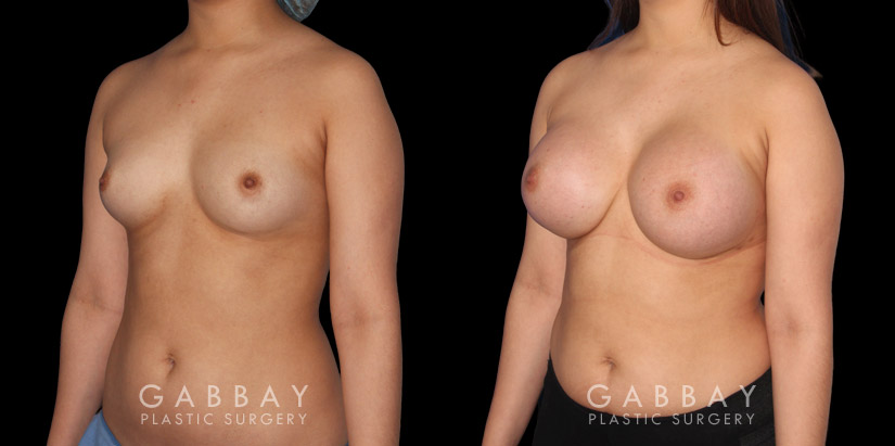 Silicone breast implants after full recovery. Patient increased breasts by several cup sizes without stretching out the skin, maintaining a round alluring shape with boosted volume.