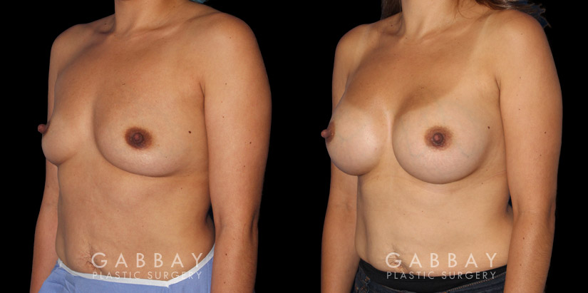 Silicone implants used to increase breast volume while keeping a natural shape. Patient healed well with no complications.