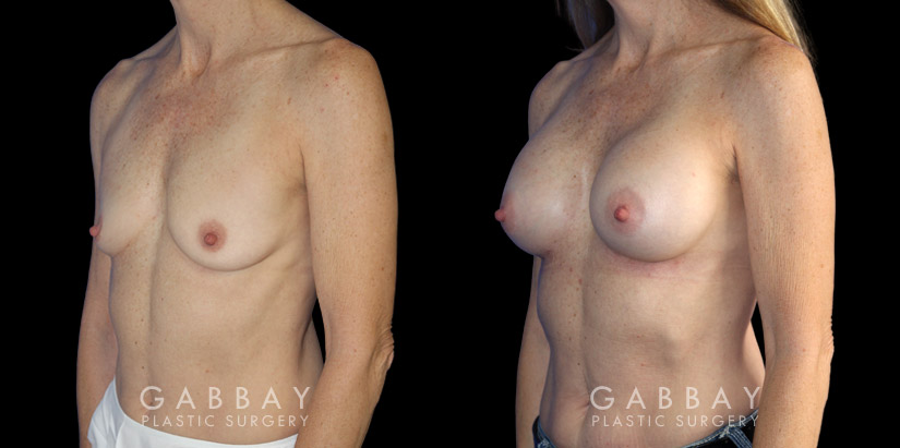Female patient in her late 40s with breast augmentation results using silicone implants. Patient healed well and achieved a breast size and appearance that enhances a youthful contour and appearance.
