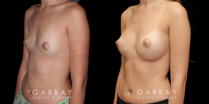 Before and after silicone breast implants for breast augmentation. Note the natural slope to the breasts and the symmetrical appearance while still increasing overall size.