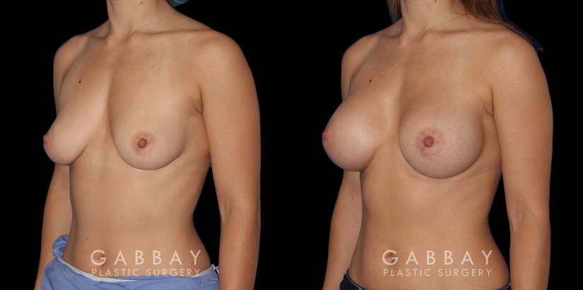 Silicone breast implants results. Note how the breast slope was retained in profile while still achieving a notable bust silhouette.