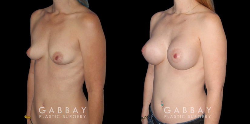 Silicone implants results for female patient in her 30s. Smaller, loose breasts were augmented to a firmer, taut volume with minimal overhang for improved comfort.