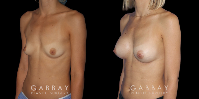 Using silicone implants, the patient saw increased breast volume while maintaining a comfortable, proportionate size. Nipple position and overall breast aesthetic was maintained while increasing size.