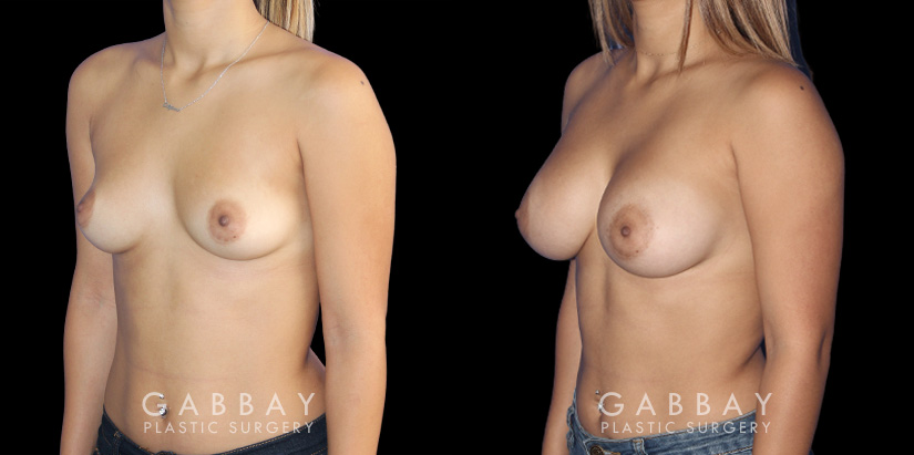 Visual of results following recovery for breast augmentation with saline implants. Patient shows dramatic increase in breast volume while keeping a more natural slope and shape to the breasts.